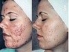 Grade IV Cystic Acne, Scarring, Hyperpigmentation